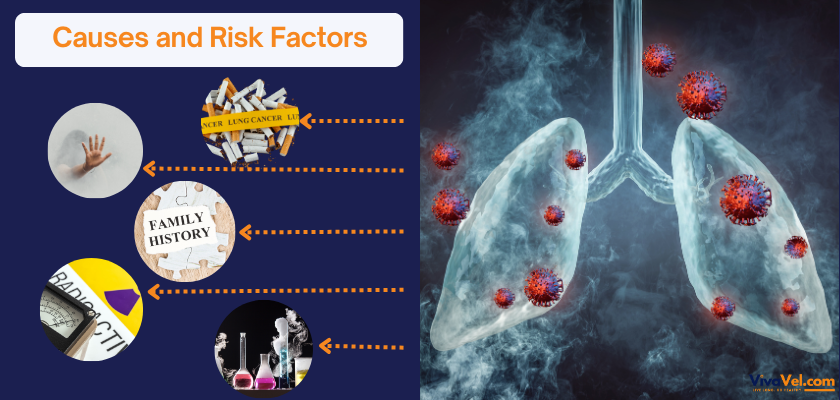 Causes and Risk Factors for Lung Cancer