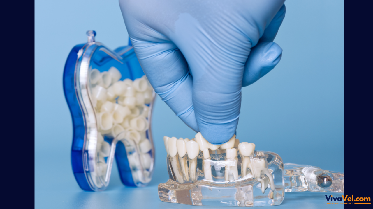 Dental Bridge Treatment | Tooth Replacement & Smile Restoration Abroad | VivaVel Health | India