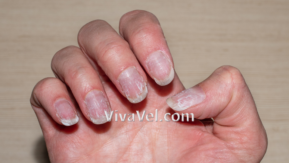 Nail Fungus Treatment in India | Advanced Onychomycosis Care | VivaVel Health