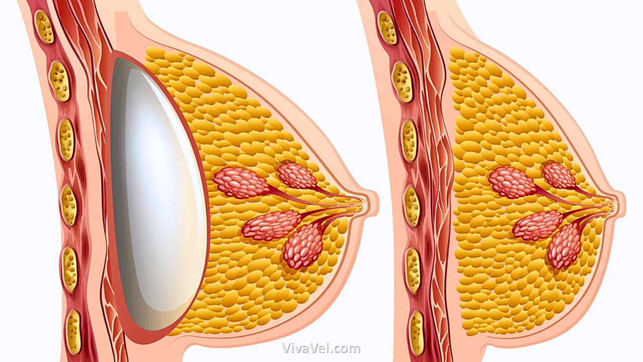 Breast reconstruction with implant surgery restoring breast shape for international patients in India